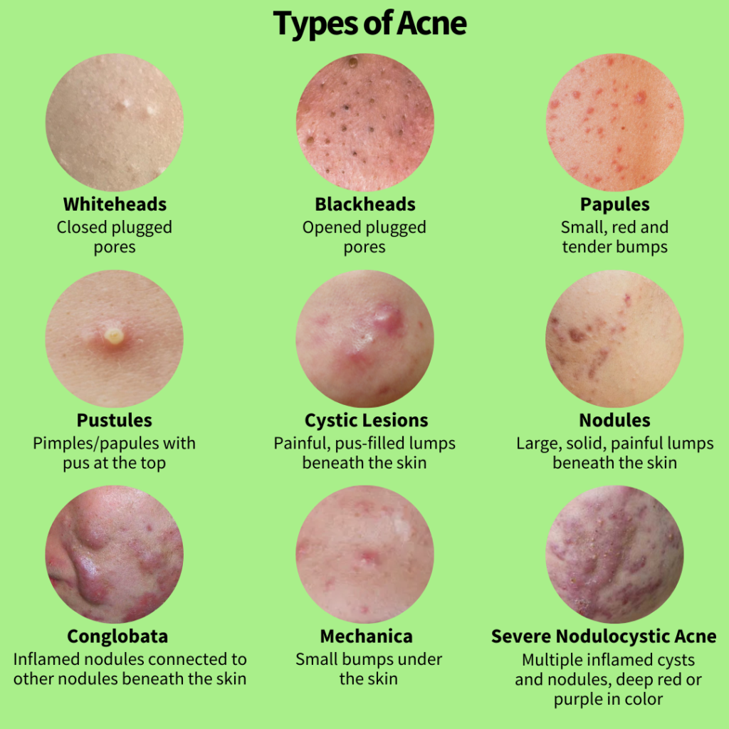 do-you-know-what-type-of-pimples-you-have-and-how-to-get-rid-of-them